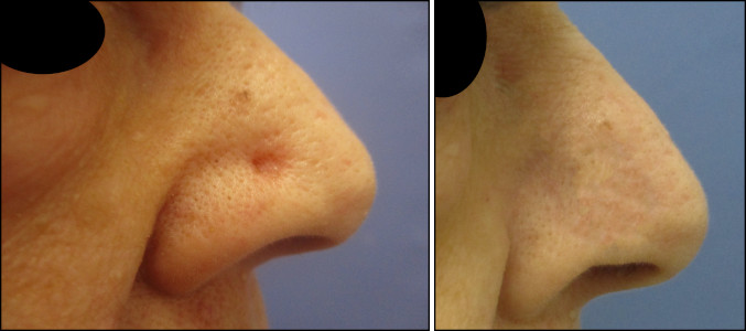 facelift